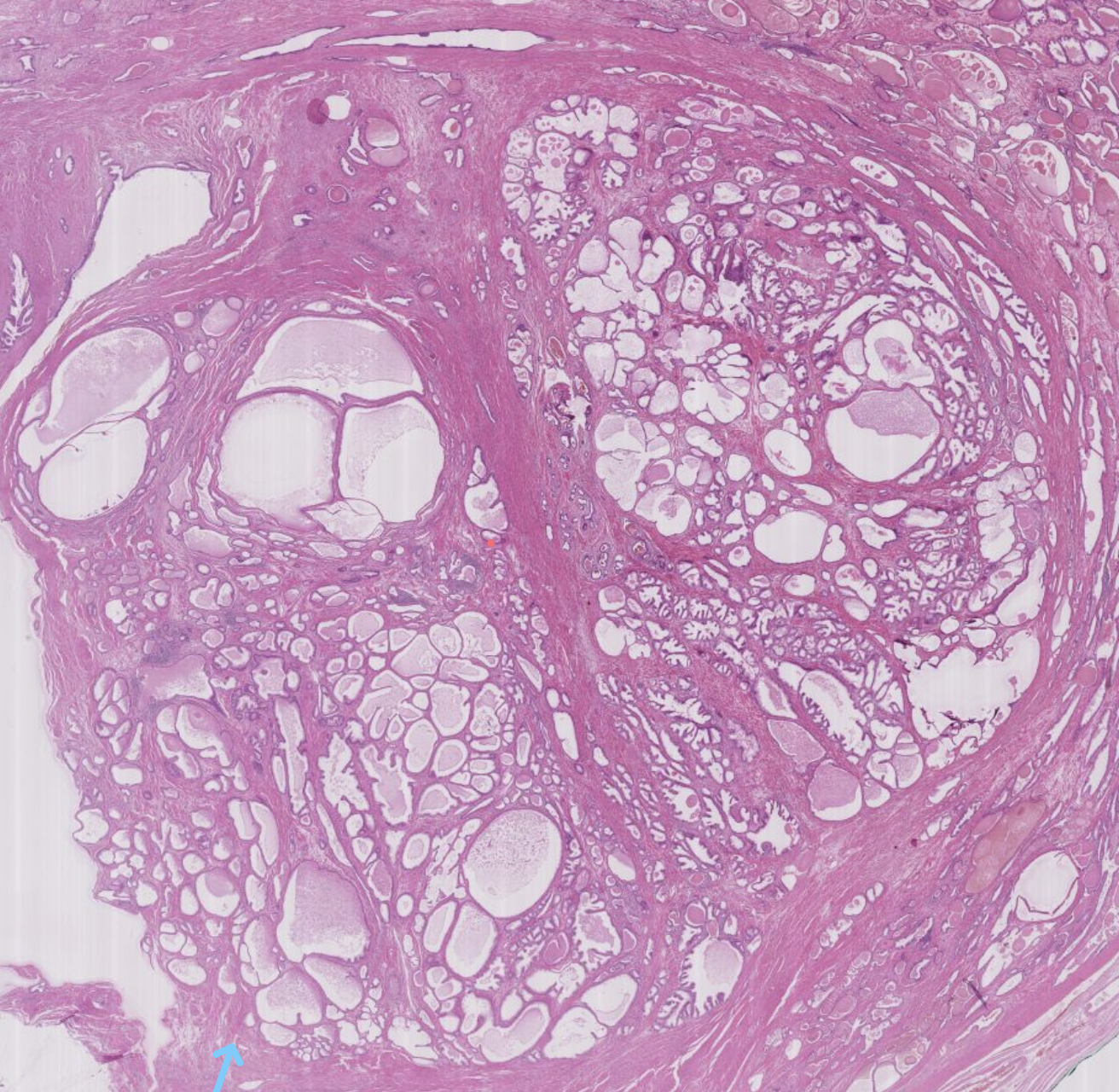 Histopathologisches Bild: Prostatahyperplasie mit knotiger Architektur